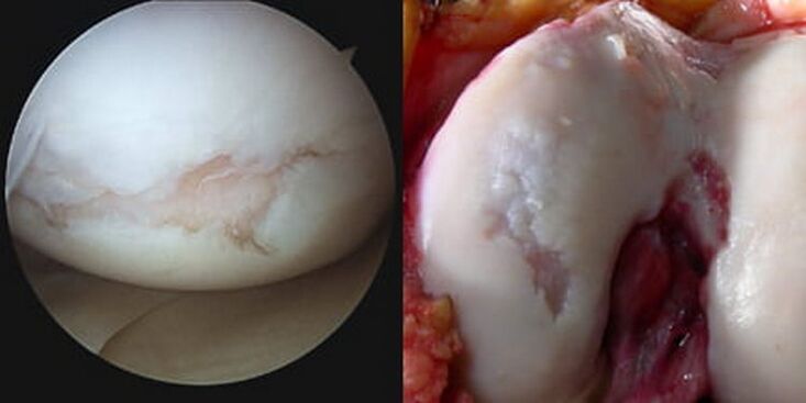 dano à articulação do joelho é visível durante a operação