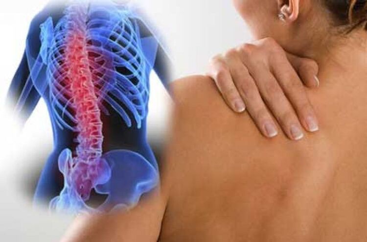 Com osteocondrose, a dor pode irradiar para partes distantes do corpo