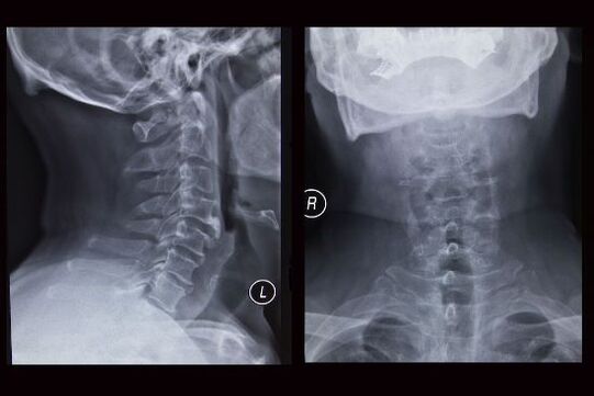 Imagem de raio-x da coluna cervical (o paciente tem osteocondrose)