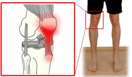 A tendinite é uma inflamação do tecido do tendão que causa dor na articulação do joelho. 