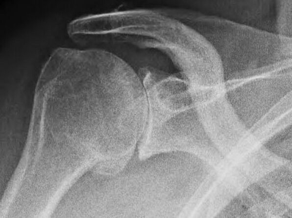 Radiografia de uma articulação do ombro afetada por artrose