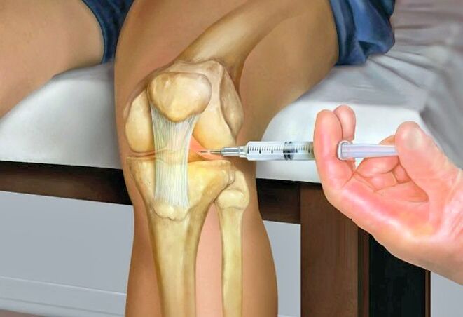 Tratamento da artrose da articulação do joelho