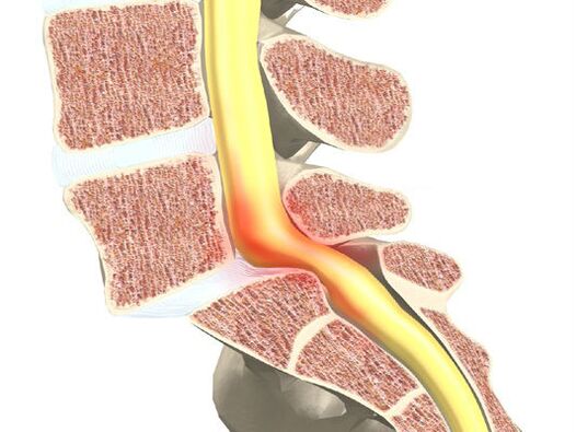 Segmento de motores sanguíneos para osteocondrose