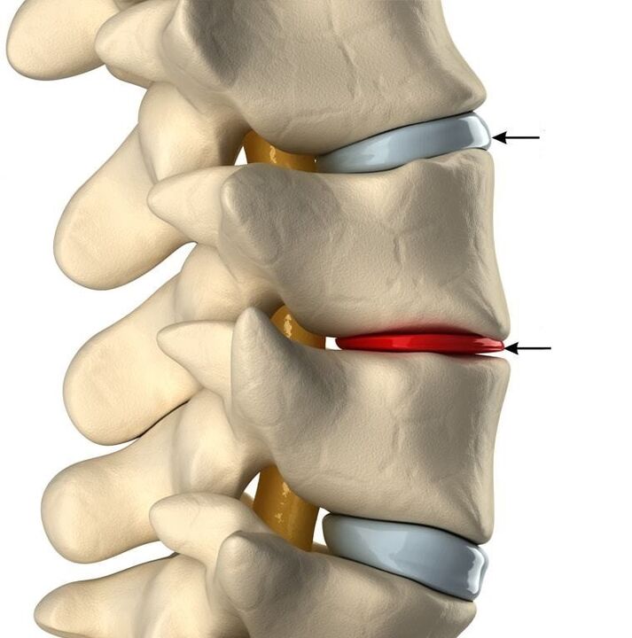 diferença entre um disco saudável e um disco com osteocondrose