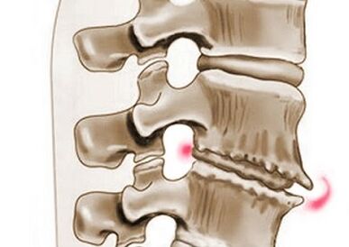 danos às vértebras na osteocondrose torácica