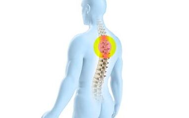 osteocondrose da coluna torácica