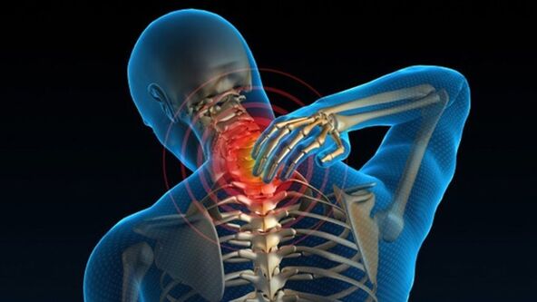 Dor ao virar o pescoço pode indicar síndrome de osteocondrose cervical vertebral