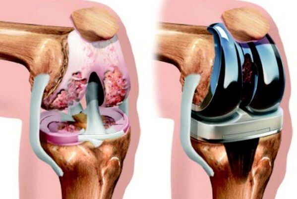 antes e depois da artrose da articulação do joelho para artrose