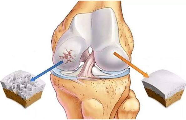 cartilagem saudável e cartilagem afetada por artrose