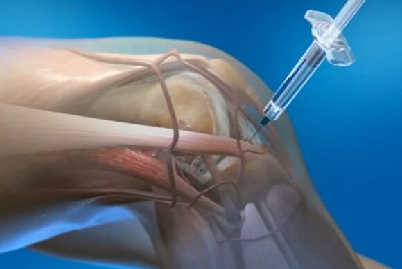 injeções intra-articulares para artrose da articulação do joelho